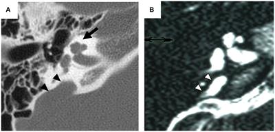 The role of SLC26A4 in bony labyrinth development and otoconial mineralization in mouse models